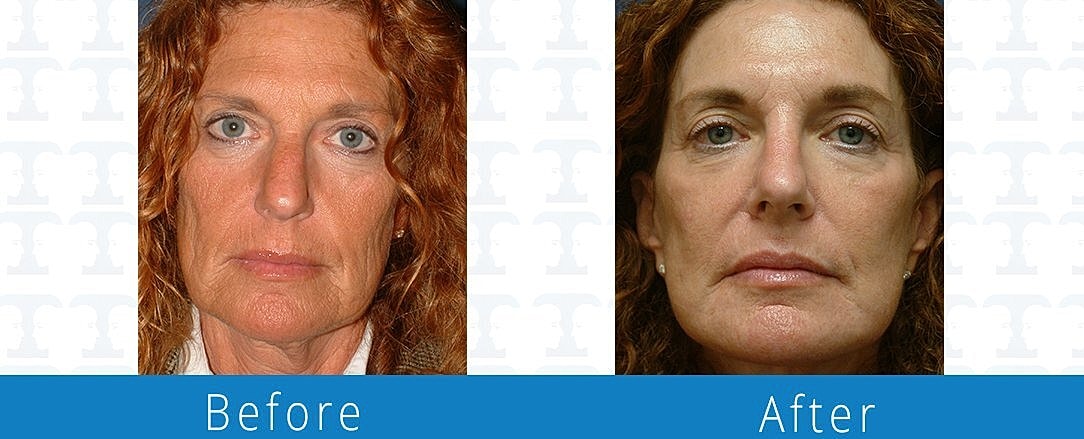 Facelift Before & After