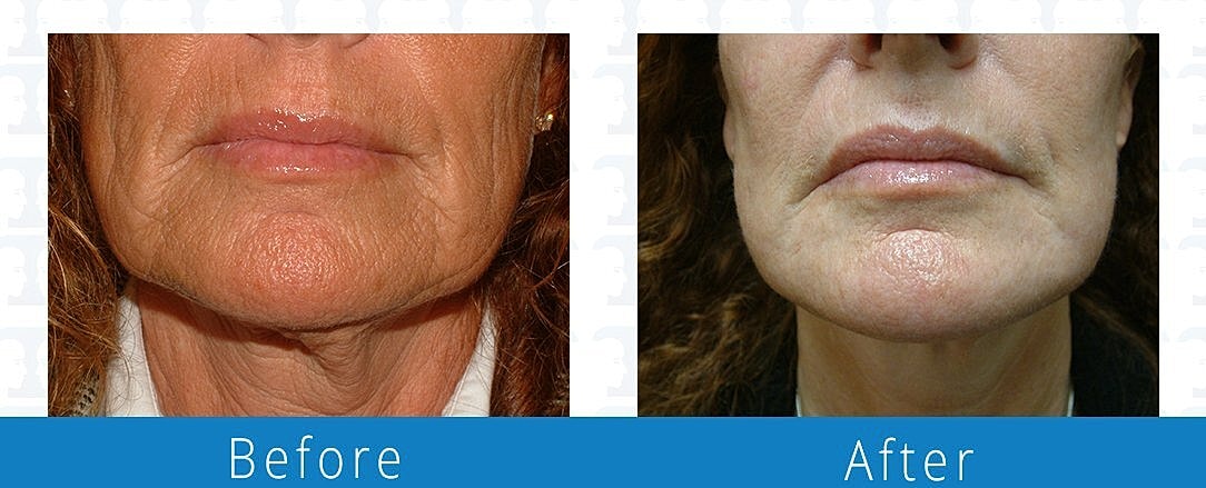 Facelift Before & After
