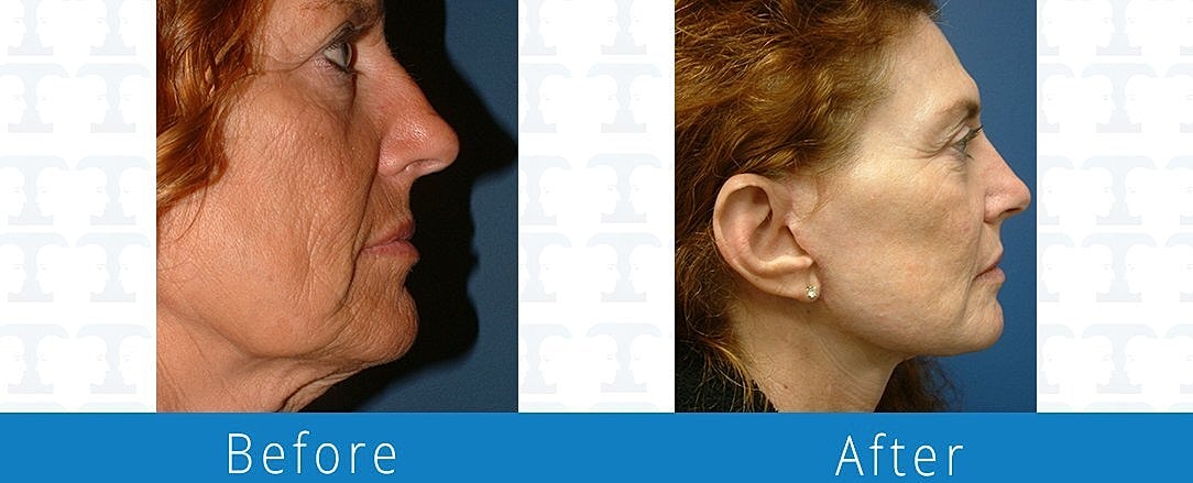 Facelift Before & After
