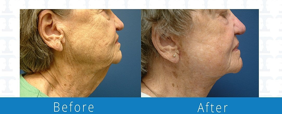 Facelift Before & After