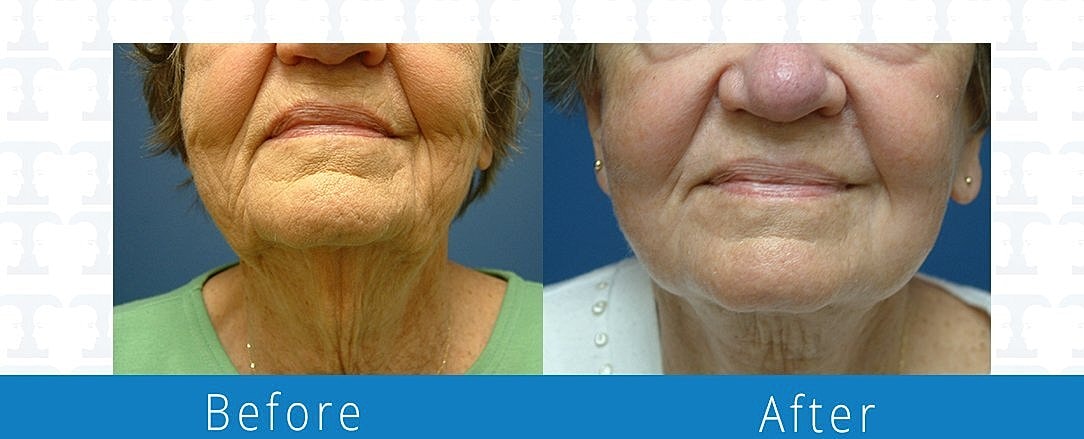 Facelift Before & After