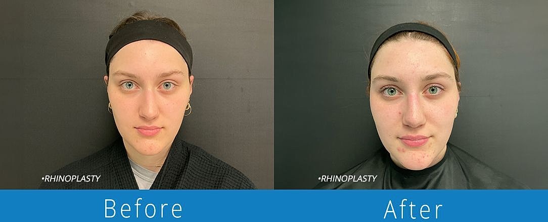 Rhinoplasty Before & After