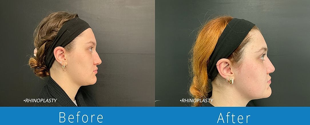 Rhinoplasty Before & After
