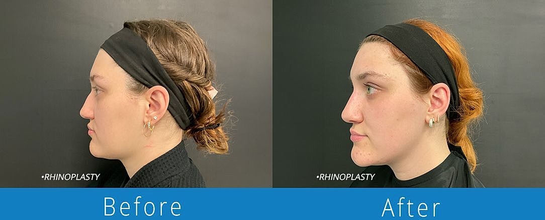 Rhinoplasty Before & After
