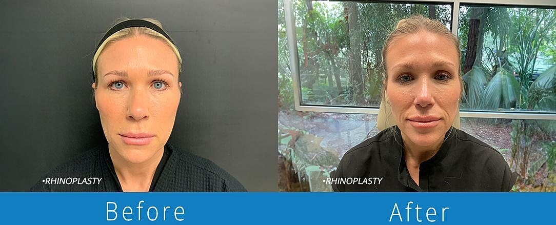 Rhinoplasty Before & After