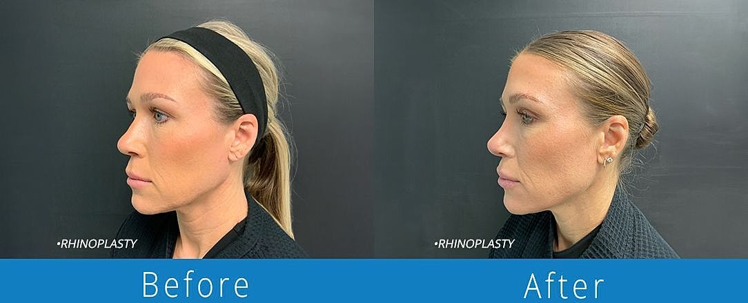 Rhinoplasty Before & After