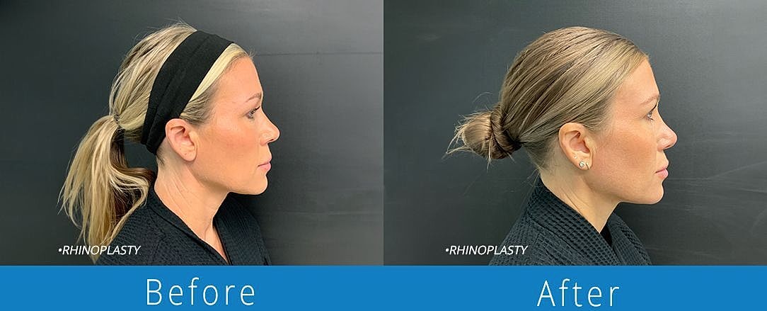 Rhinoplasty Before & After