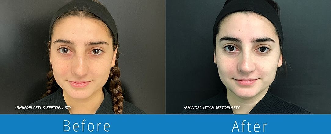 Rhinoplasty Before & After