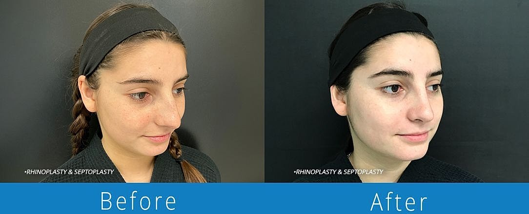 Rhinoplasty Before & After