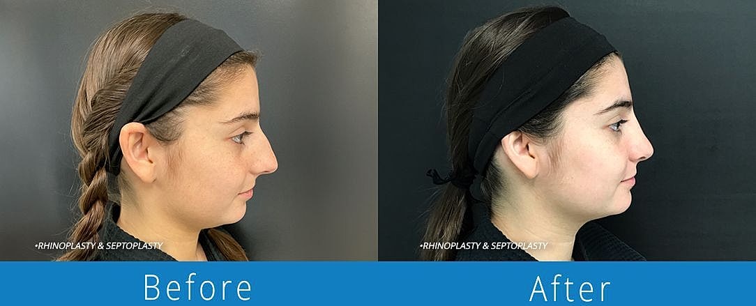 Rhinoplasty Before & After