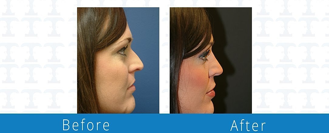 Rhinoplasty Before & After