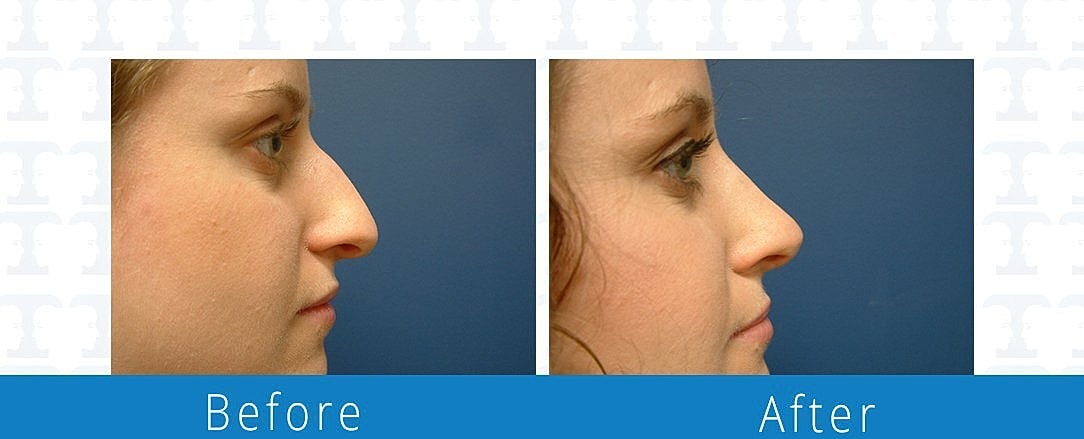 Rhinoplasty Before & After