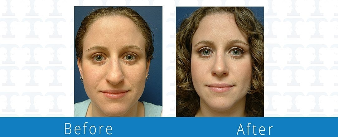 Rhinoplasty Before & After