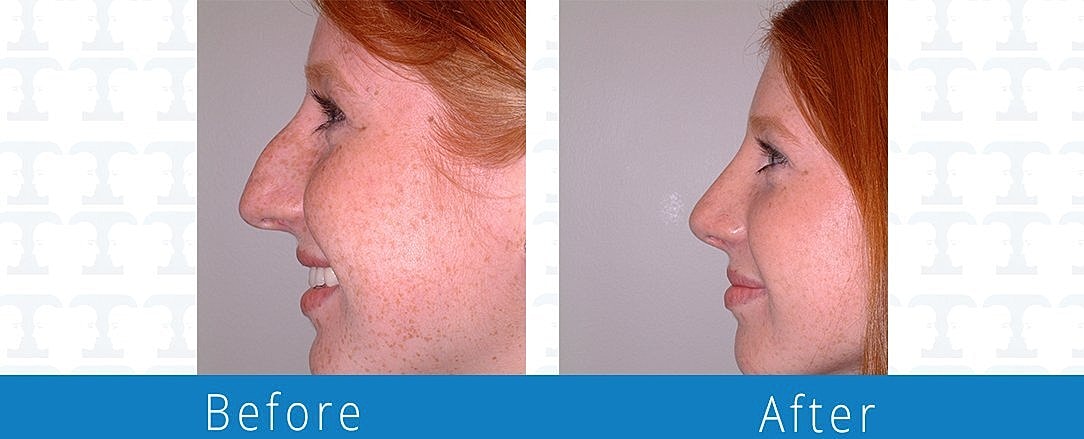 Rhinoplasty Before & After