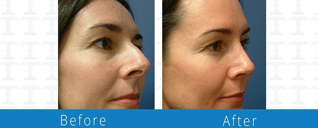 Rhinoplasty Before & After