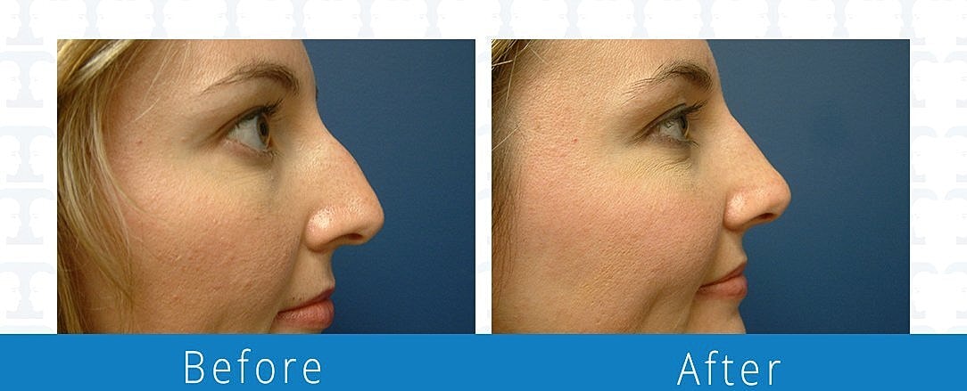 Rhinoplasty Before & After