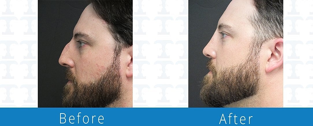Rhinoplasty Before & After