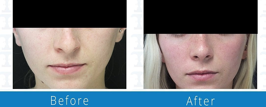Rhinoplasty Before & After