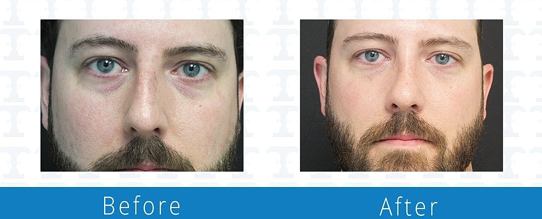 Rhinoplasty Before & After