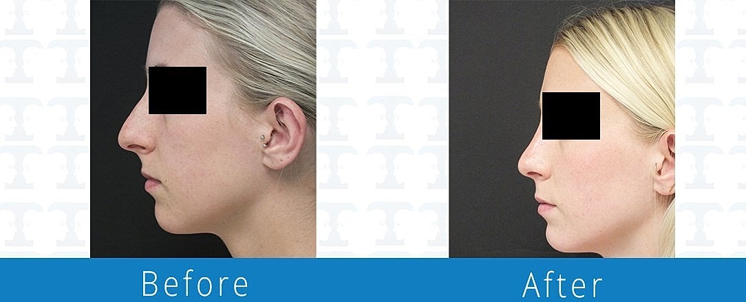 Rhinoplasty Before & After