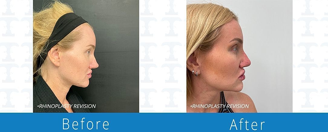 Rhinoplasty Before & After