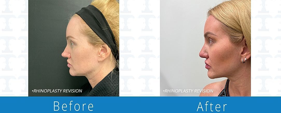 Rhinoplasty Before & After