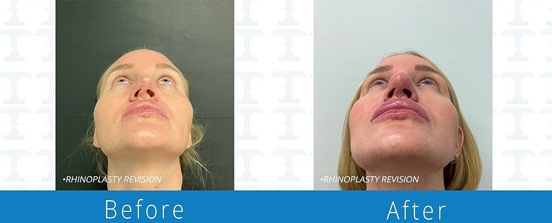 Rhinoplasty Before & After