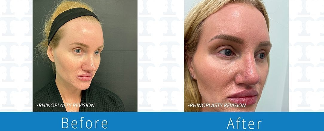 Rhinoplasty Before & After