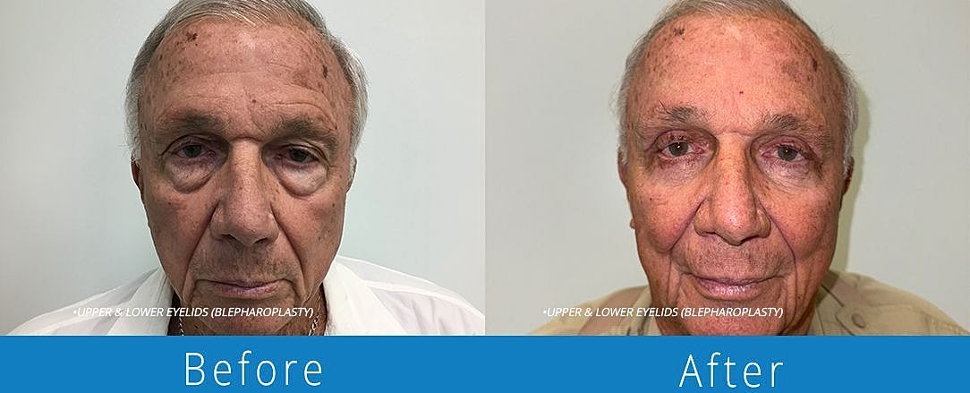 Blepharoplasty Before & After
