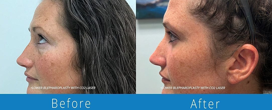 Blepharoplasty Before & After