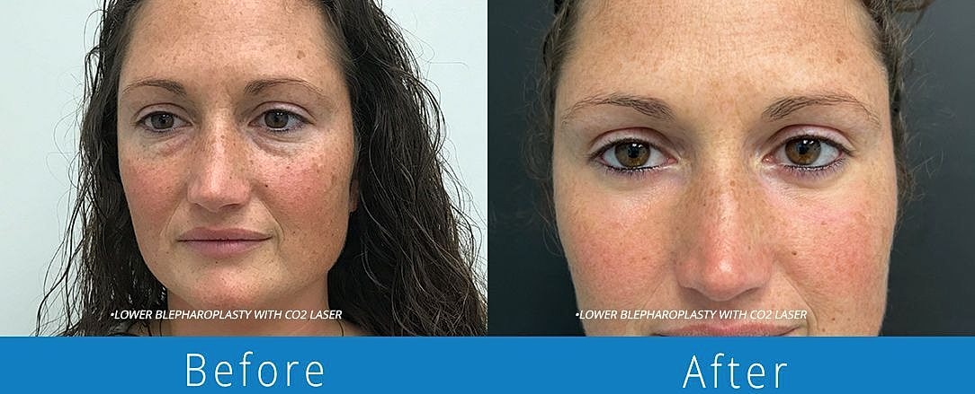 Blepharoplasty Before & After