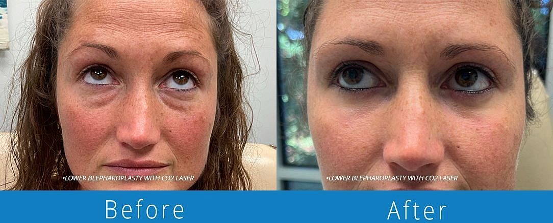 Blepharoplasty Before & After