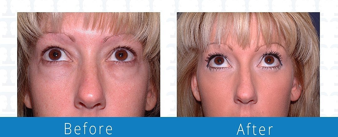 Blepharoplasty Before & After