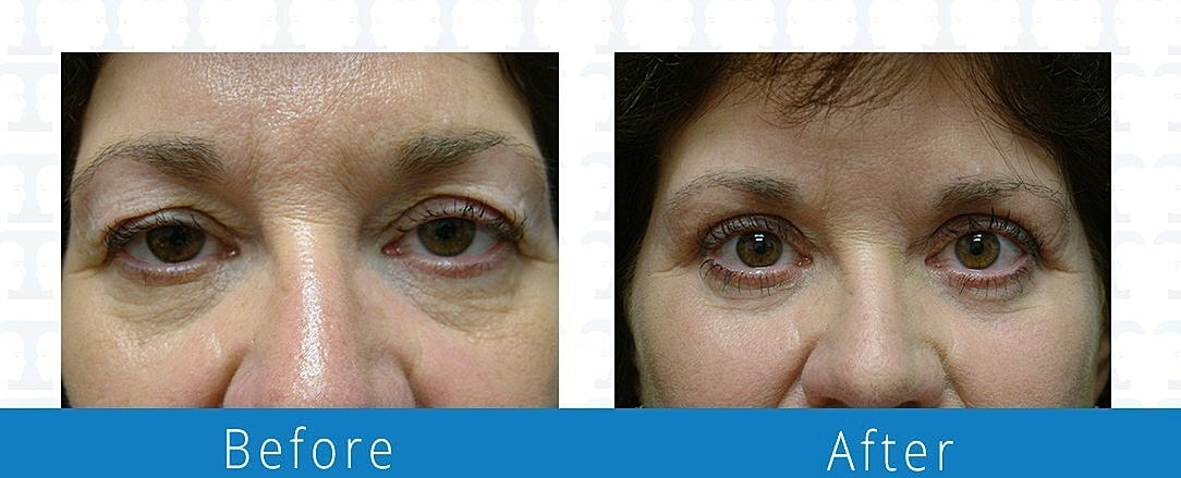 Blepharoplasty Before & After