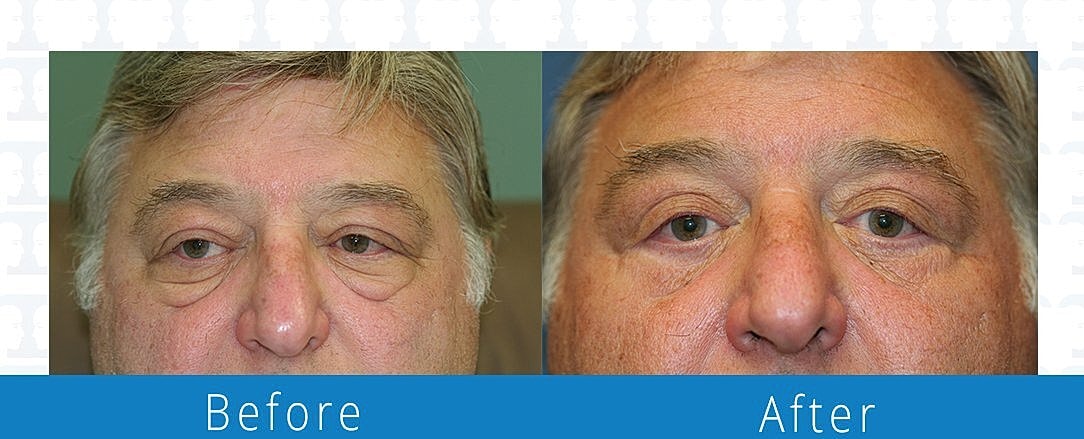 Blepharoplasty Before & After