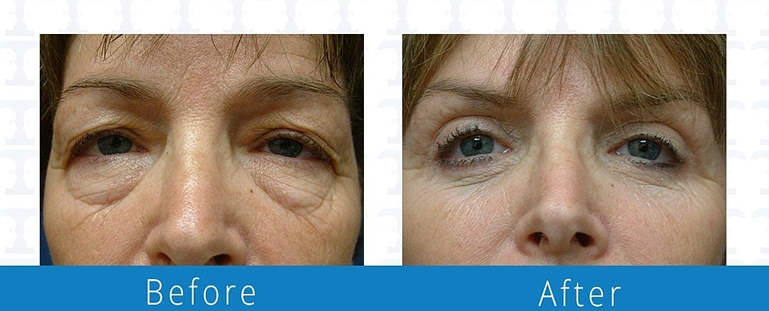 Blepharoplasty Before & After