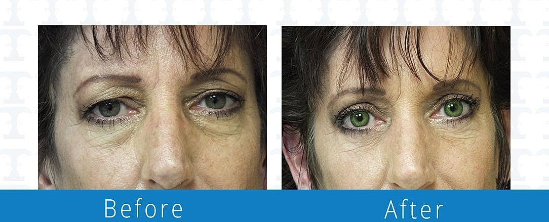 Blepharoplasty Before & After