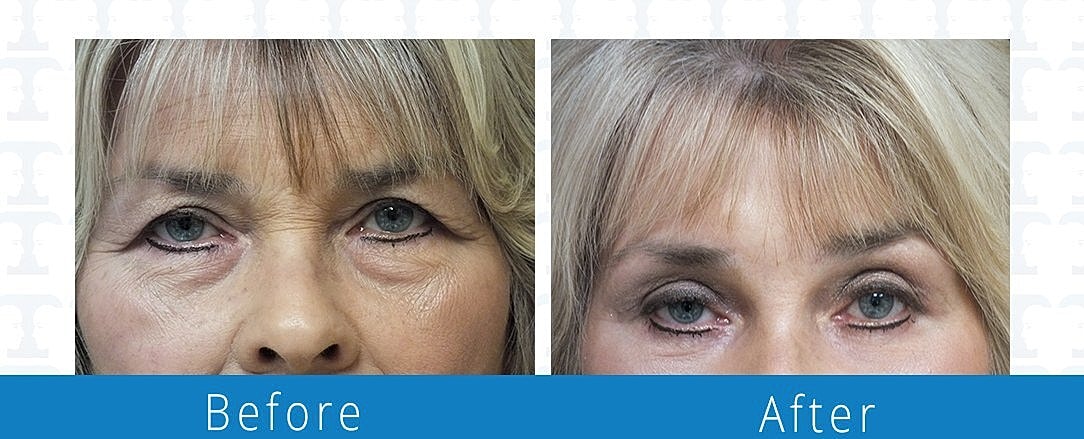 Blepharoplasty Before & After