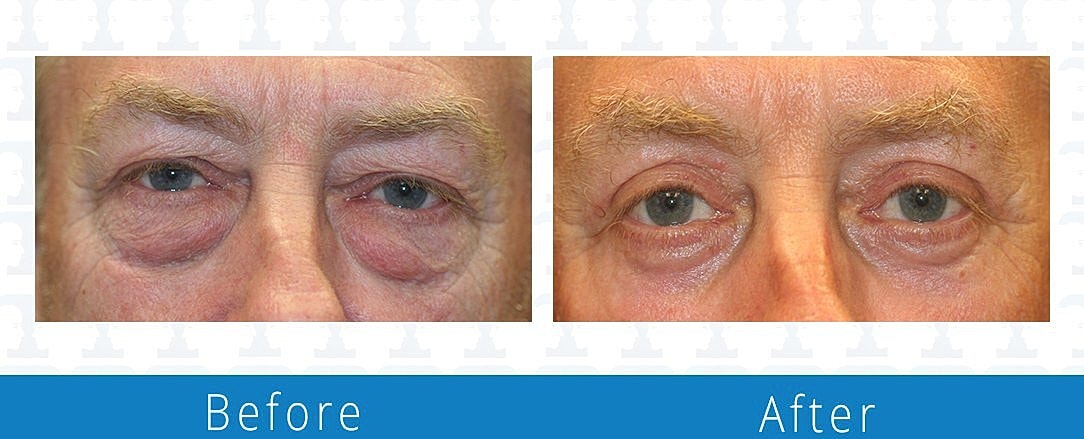 Blepharoplasty Before & After