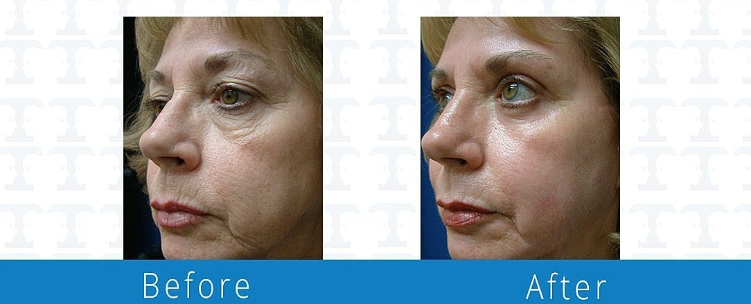Blepharoplasty Before & After