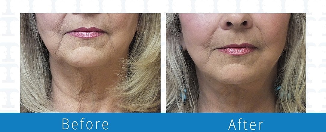 Neck Lift Before & After