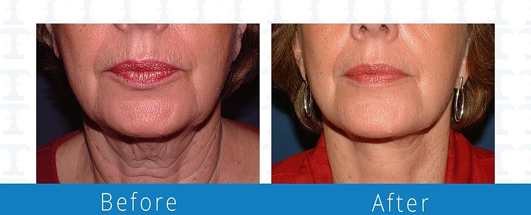 Neck Lift Before & After