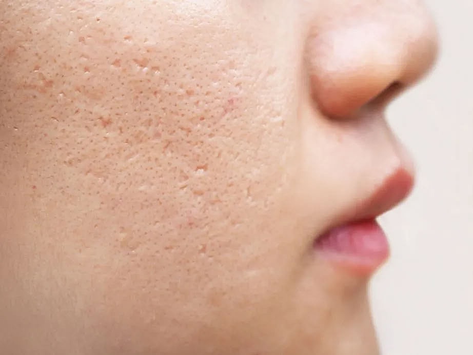 Close-up of skin with visible pores.