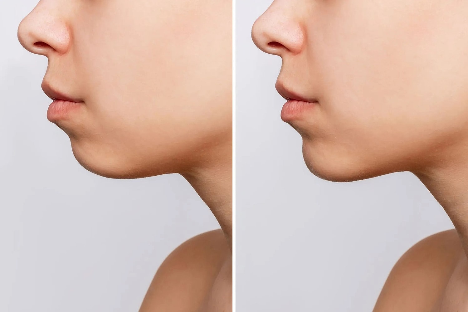 Before and after jawline enhancement photos.