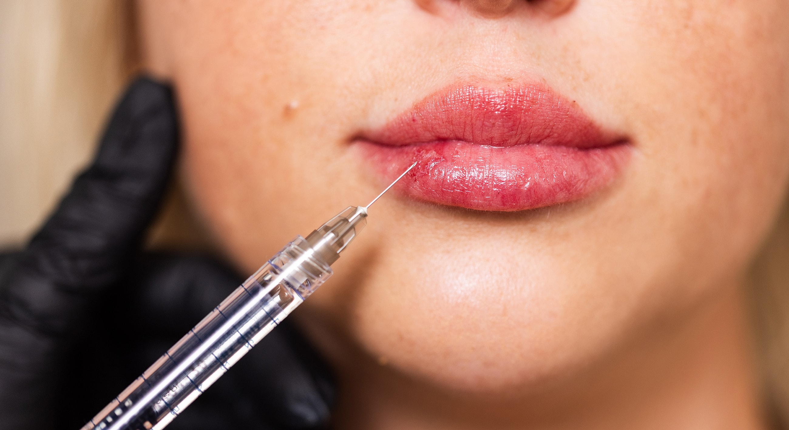 Lip injection procedure with syringe and gloved hand